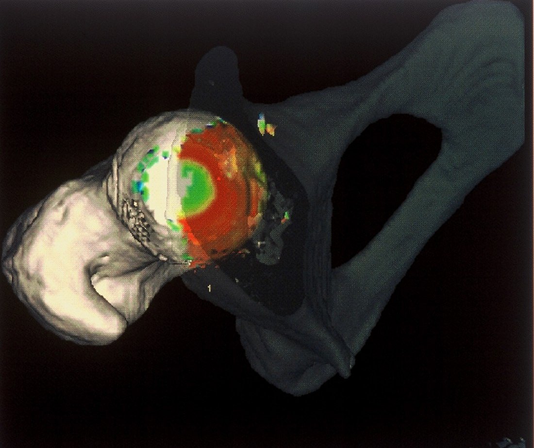 Kontaktfläche im Hüftgelenk