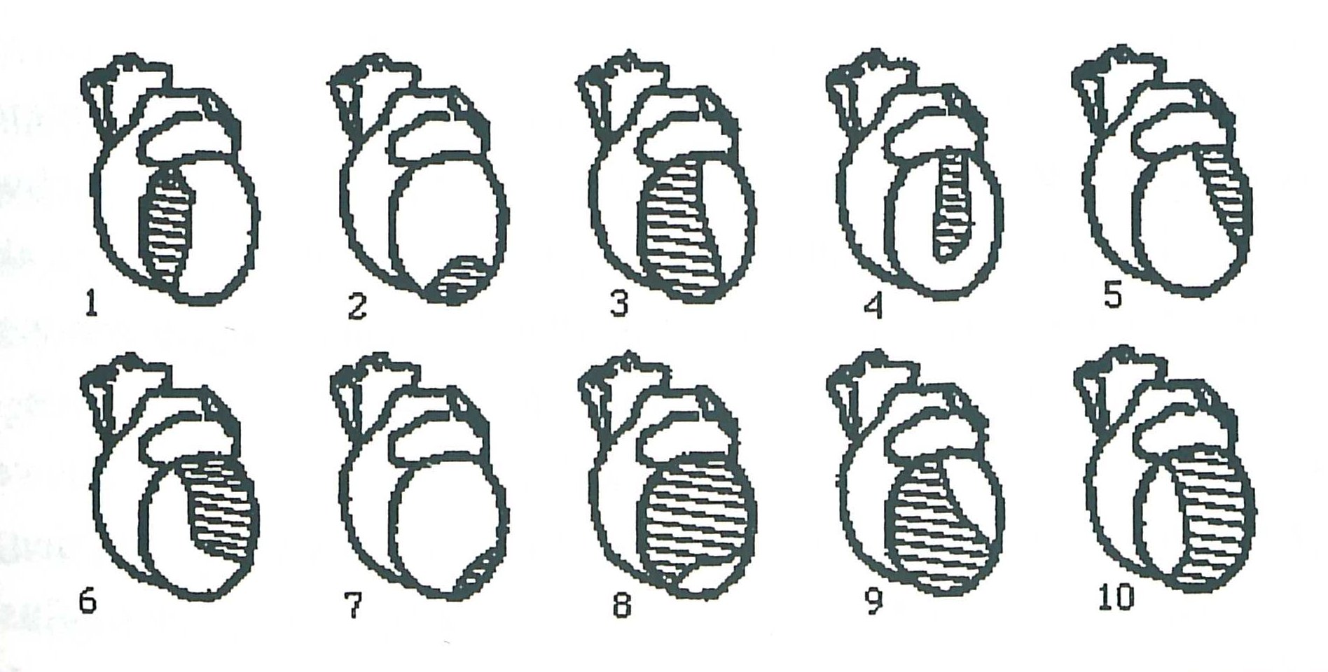 Linksventrikuläre Infarkttypen